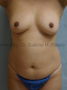  Before and After Cosmetic Surgery in Oakland, CA 