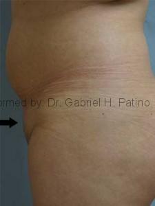  Before and After Cosmetic Surgery in Oakland, CA 