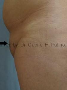  Before and After Cosmetic Surgery in Oakland, CA 