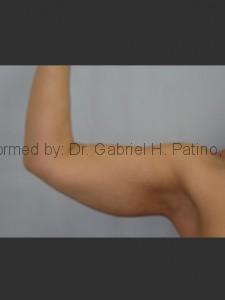  Before and After Cosmetic Surgery in Oakland, CA 