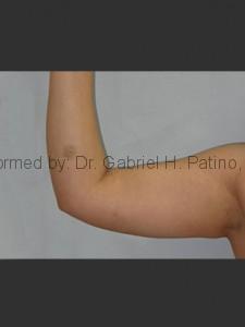  Before and After Cosmetic Surgery in Oakland, CA 