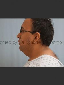  Before and After Cosmetic Surgery in Oakland, CA 