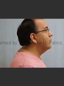  Before and After Cosmetic Surgery in Oakland, CA 