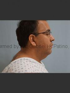  Before and After Cosmetic Surgery in Oakland, CA 