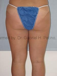  Before and After Cosmetic Surgery in Oakland, CA 