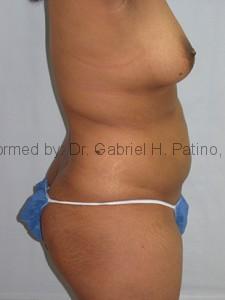  Before and After Cosmetic Surgery in Oakland, CA 