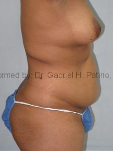  Before and After Cosmetic Surgery in Oakland, CA 