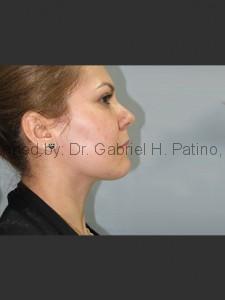  Before and After Cosmetic Surgery in Oakland, CA 