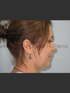  Before and After Cosmetic Surgery in Oakland, CA 