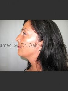  Before and After Cosmetic Surgery in Oakland, CA 