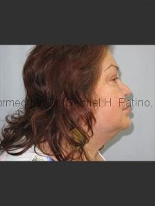  Before and After Cosmetic Surgery in Oakland, CA 