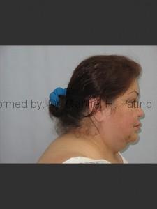  Before and After Cosmetic Surgery in Oakland, CA 