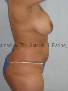  Before and After Cosmetic Surgery in Oakland, CA 