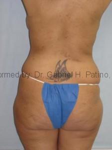  Before and After Cosmetic Surgery in Oakland, CA 