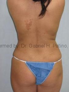  Before and After Cosmetic Surgery in Oakland, CA 