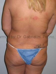  Before and After Cosmetic Surgery in Oakland, CA 