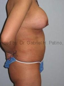  Before and After Cosmetic Surgery in Oakland, CA 