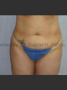  Before and After Cosmetic Surgery in Oakland, CA 