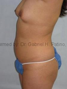  Before and After Cosmetic Surgery in Oakland, CA 