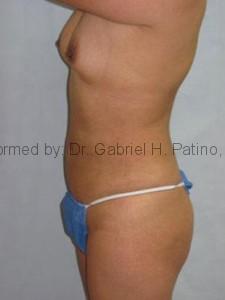  Before and After Cosmetic Surgery in Oakland, CA 