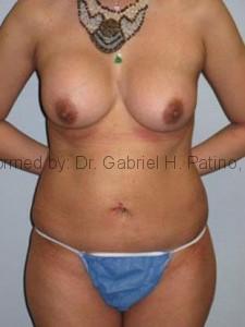  Before and After Cosmetic Surgery in Oakland, CA 