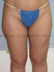  Before and After Cosmetic Surgery in Oakland, CA 