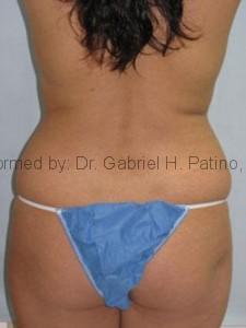  Before and After Cosmetic Surgery in Oakland, CA 