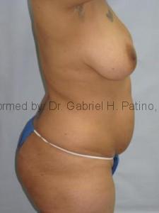  Before and After Cosmetic Surgery in Oakland, CA 