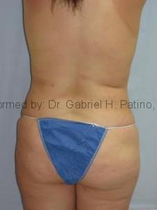  Before and After Cosmetic Surgery in Oakland, CA 