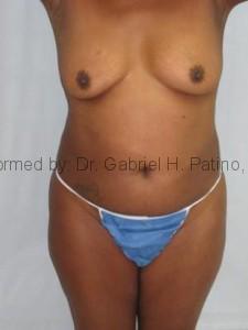  Before and After Cosmetic Surgery in Oakland, CA 