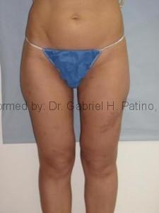  Before and After Cosmetic Surgery in Oakland, CA 