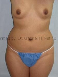  Before and After Cosmetic Surgery in Oakland, CA 