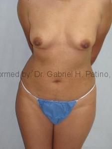  Before and After Cosmetic Surgery in Oakland, CA 