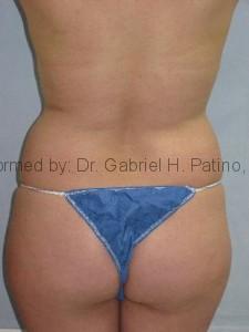  Before and After Cosmetic Surgery in Oakland, CA 