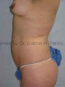  Before and After Cosmetic Surgery in Oakland, CA 