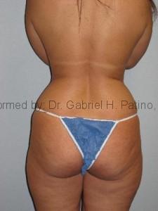  Before and After Cosmetic Surgery in Oakland, CA 