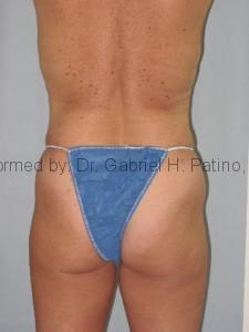  Before and After Cosmetic Surgery in Oakland, CA 