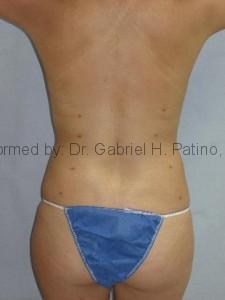  Before and After Cosmetic Surgery in Oakland, CA 