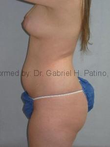  Before and After Cosmetic Surgery in Oakland, CA 