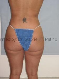  Before and After Cosmetic Surgery in Oakland, CA 