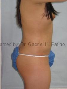  Before and After Cosmetic Surgery in Oakland, CA 