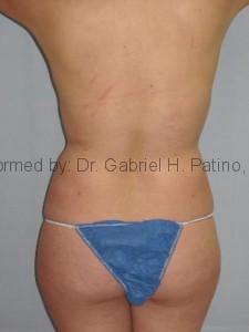  Before and After Cosmetic Surgery in Oakland, CA 