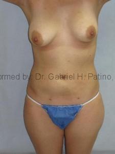  Before and After Cosmetic Surgery in Oakland, CA 