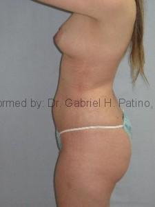  Before and After Cosmetic Surgery in Oakland, CA 