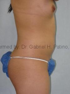  Before and After Cosmetic Surgery in Oakland, CA 