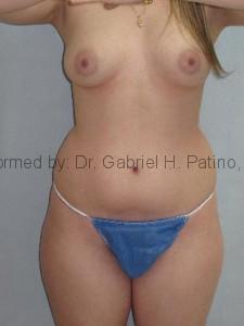  Before and After Cosmetic Surgery in Oakland, CA 