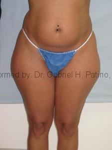  Before and After Cosmetic Surgery in Oakland, CA 