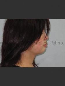  Before and After Cosmetic Surgery in Oakland, CA 