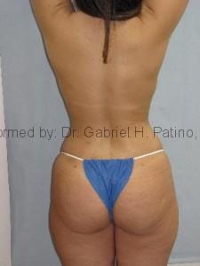  Before and After Cosmetic Surgery in Oakland, CA 