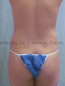  Before and After Cosmetic Surgery in Oakland, CA 